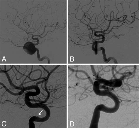 A Lateral Digital Subtraction Angiography Of The Left Ica In A