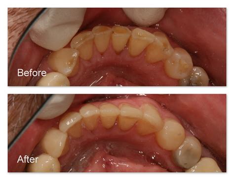 Restoration Of Worn Teeth Dr Jack M Hosner Dds