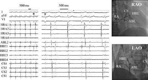 Slow Pathway Ablation Induces Junctional Rhythm With Ventriculoatrial