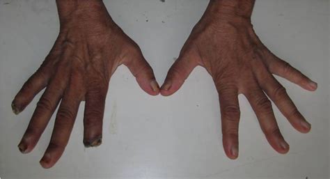 Takayasus Arteritis Presenting As Digital Gangrene Of Right Hand Bmj