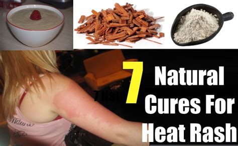 7 Natural Cures For Heat Rash – Natural Home Remedies & Supplements