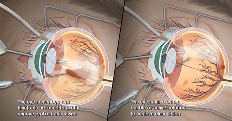 What Is Vitrectomy Hill Regional Hospital