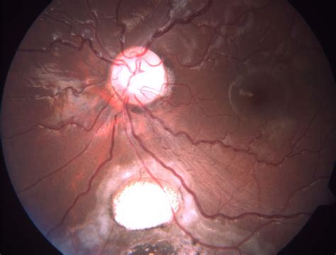 Fundus Photograph In Type V Coloboma Download Scientific Diagram