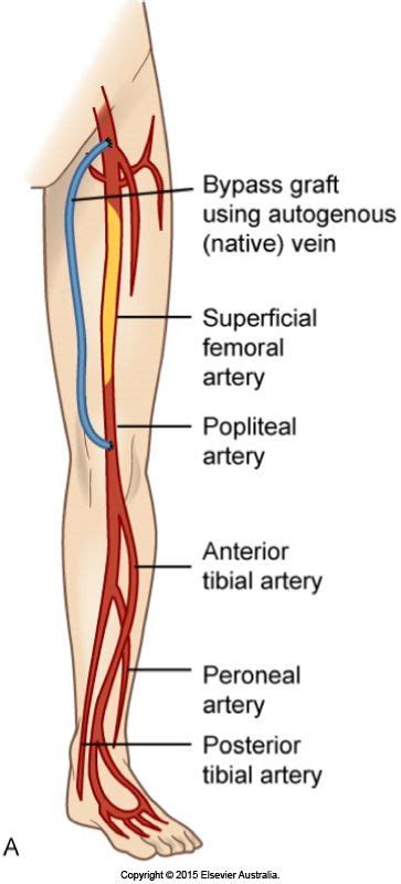 Femoral Popliteal Bypass Graft Around An Occluded Superficial Femoral Artery Vascular Surgery