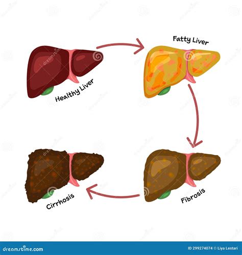 Estadio De Daño Hepático Fibrosis Hepática Grasosa Cirrosis Enfermedad