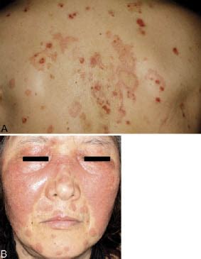 A Case Of Igg Iga Pemphigus Presenting Malar Rash Like Erythema Html