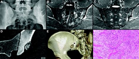 Clinical Images Osteoblastoma Of The Ilium Mimicking Sacroiliitis