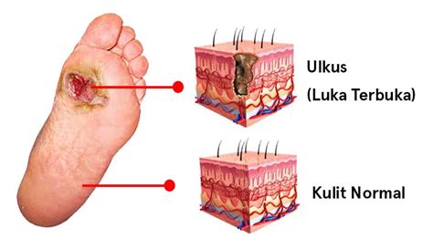 Tips Mengatasi Luka Pada Penderita Diabetes