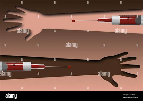 Las Donaciones Y Transfusiones De Sangre Se Ilustran Aquí Con Jeringas Sangre Y Dos Brazos