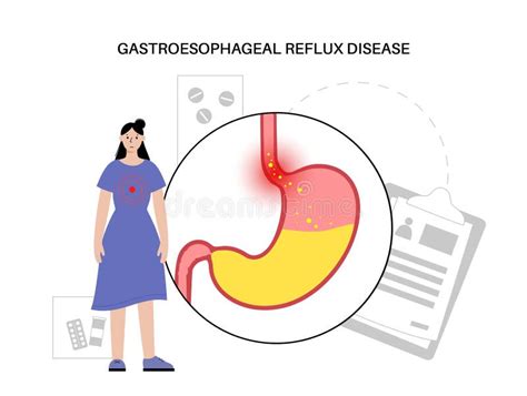 Gastroesophageal Reflux Disease Stock Vector Illustration Of Diagram