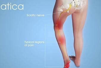 Sciatica Causes Signs And Symptoms Diagnosis And Treatment Paperblog