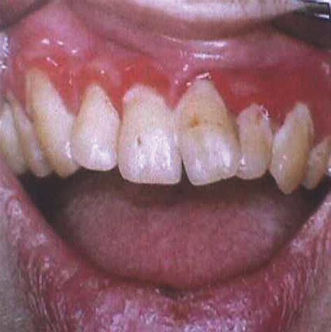 Linear Gingival Erythema