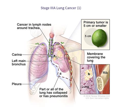 Lung Cancer Staging Virginia Oncology