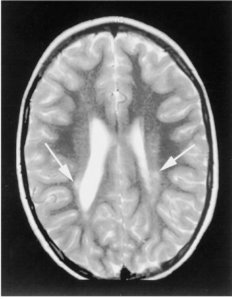 This Mri T Weighted Image Is From A Year Old Girl Born At