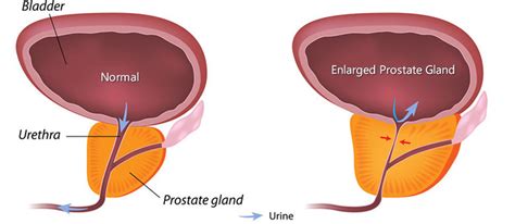 Prepare for Medical Exams : Regarding Benign Prostatic Hyperplasia