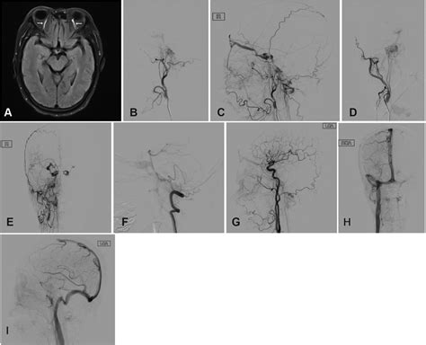 Frontiers The Combined Transarterial And Transvenous Onyx