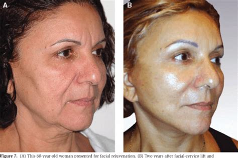 [pdf] Malar Fat Pad Repositioning In Facelifting A Simple Technique Of