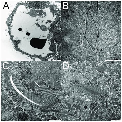 Transmission Electron Microscopy TEM Documents Podocyte Foot Process