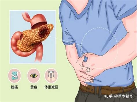 胰腺癌生存率低，该怎么预防成都普济中医肿瘤医院杨成平副主任 知乎