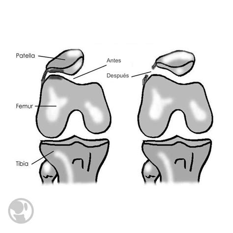 Descubre los secretos del síndrome rotuliano aware doctor