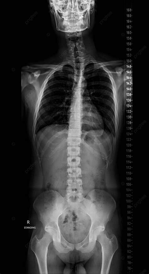 Fondo Radiograf A De Diagn Stico De Toda La Columna Vertebral Para