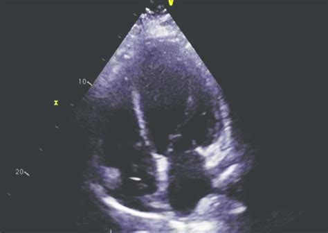 TTE image demonstrating a pattern of global hypokinesis. | Download ...