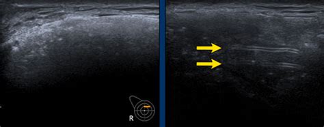 The Radiology Assistant Breast Implants