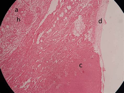 Few Acini A Surrounded By Dense Neutrophilic Infiltration B Are Download Scientific Diagram