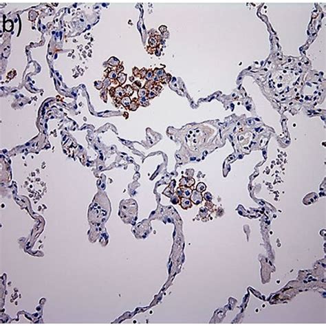 Expression Patterns Of Alveolar Macrophages Ams In The Alveolar