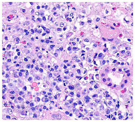 Overlapping Vasculitis And Igg Related Disease Hss Case