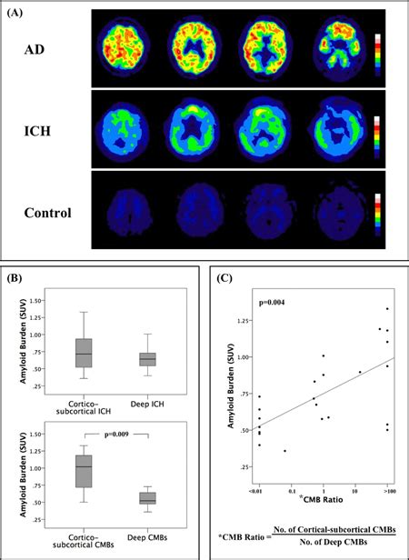 Abstract Correlation Of Cerebral Microbleeds Distribution To