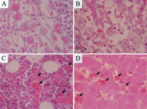 Figure 1 From Serologically Diagnosed Toxocariasis With Hemophagocytic