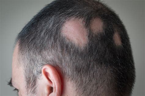 Types Of Alopecia An Overview