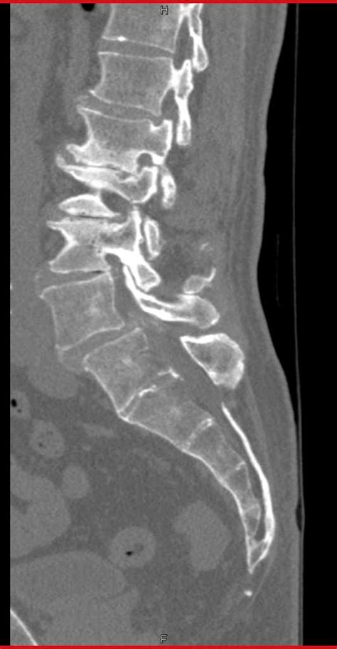 Degenerative Lumbar Spine Ct Scan Hot Sex Picture