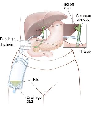 Discharge Instructions: Caring for Your T-Tube | Saint Luke's Health System