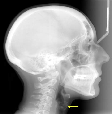 Thyroid: X Ray Thyroid