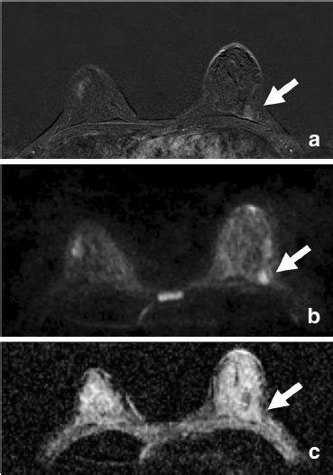 A 44 Year Old Woman With A Segmental Heterogeneous Non Mass