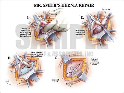 Hernia Repair Case Study - S&A Medical Graphics