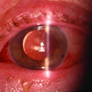 Color Photography Of The Left Eye A First Postoperative Day Slit Lamp