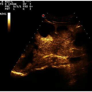 Renal Contrast Enhanced Ultrasonography Showing That The Right Renal