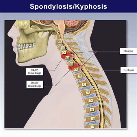 Site Of Coronary Artery Stenosis Trial Exhibits Inc