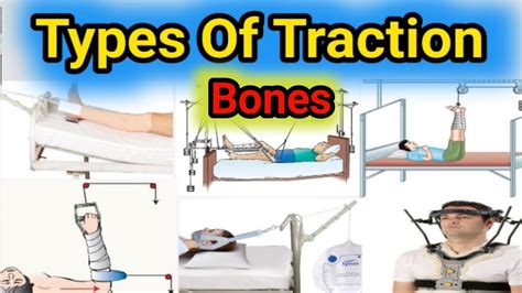 Types Of Traction Traction Types Orthopaedic Traction Skin And