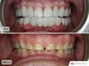 Before After Dental Implants Modern Dental Implant Solutions