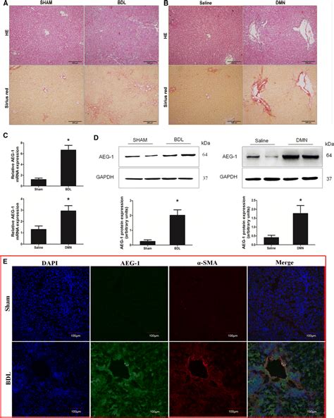 Upregulation Of Astrocyte Elevated Gene 1 AEG 1 Expression In The