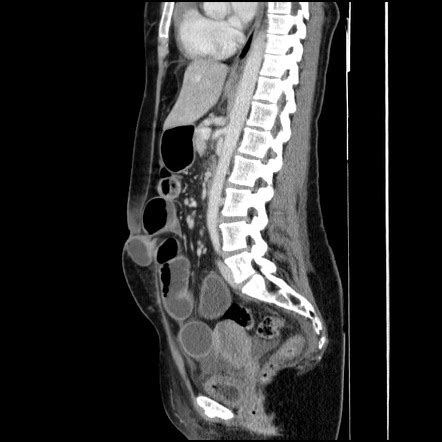 Small Bowel Obstruction Secondary To Entrapment In Laparoscopic Port