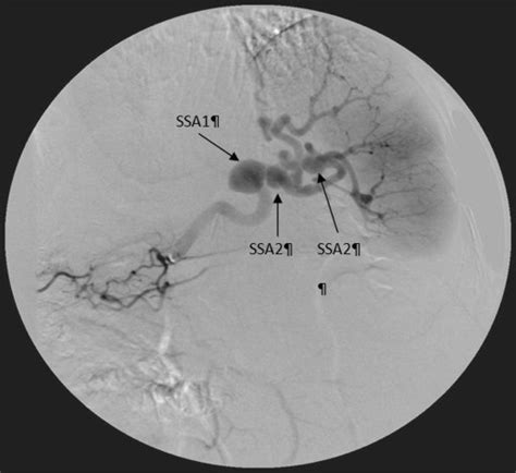 Angiography Of The Splenic Artery Showing Three Splenic Artery