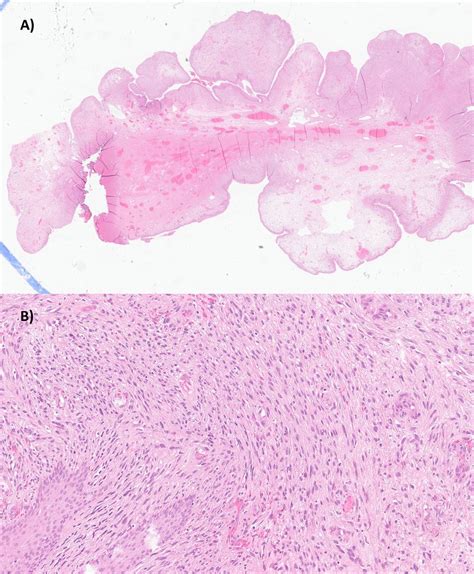 Fast Growing Fibroepithelial Stromal Vaginal Polyp Bmj Case Reports