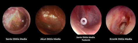 Otitis Media Post