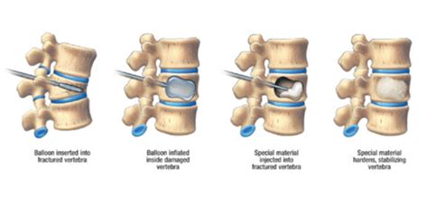 Kyphoplasty Vertebroplasty Procedure In Fredericksburg Va