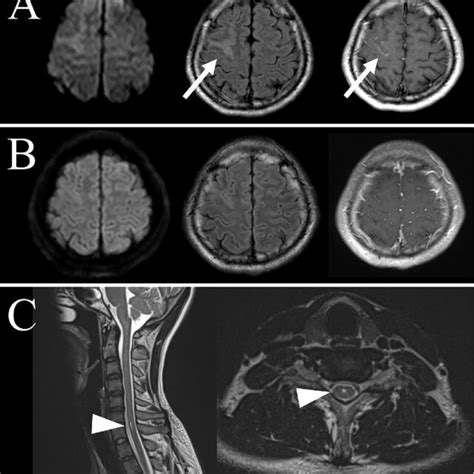 Figure Serial Brain And Cervical Magnetic Resonance Imaging Mri